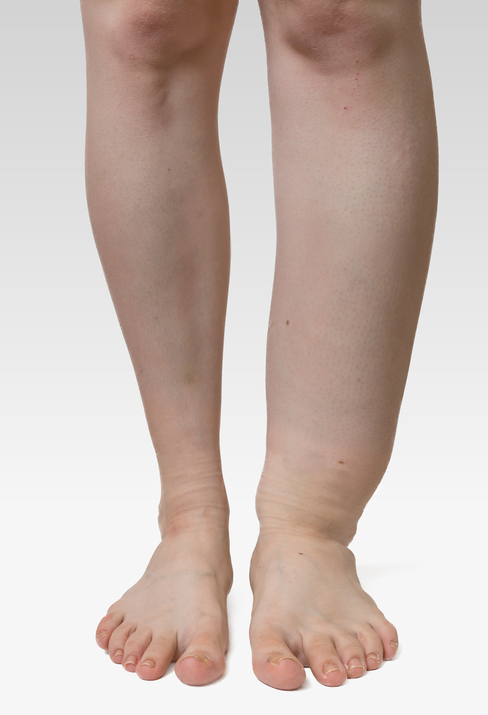 Opuch najednej dolnej končatine, ľavá dolná končatina bez opuchu, pravá opuchnutá, vysoký opuch, od nohy až po koleno