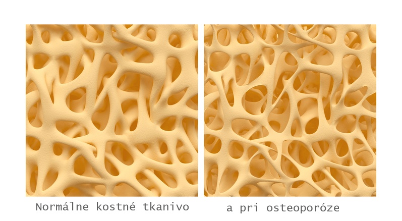Porovnanie kosti s normálnou stavbou kostného tkaniva a kostné tkanivo pri osteoporóze