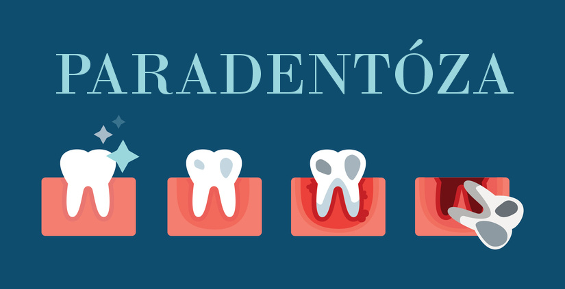 Postupnosť parodontózy, od zdravého chrupu až po vypadávanie zubov