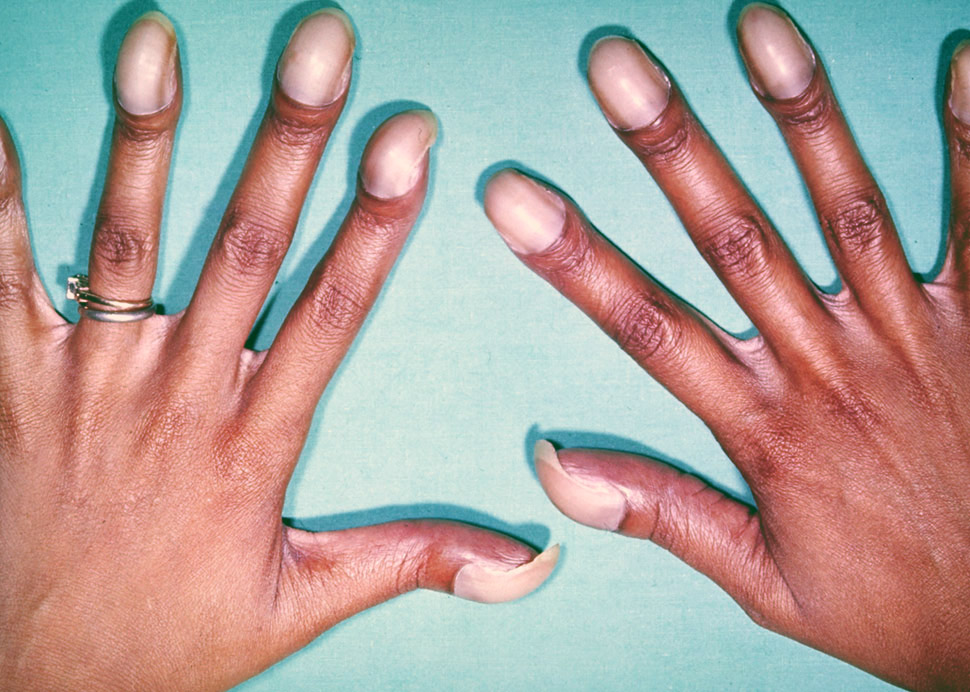 Žena má paličkovité prsty ako príznak ochorenia, a to fallotovej tetralógie