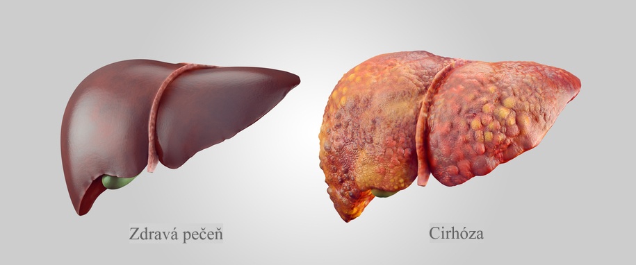 Porovnanie zdravej pečene a cirhózy