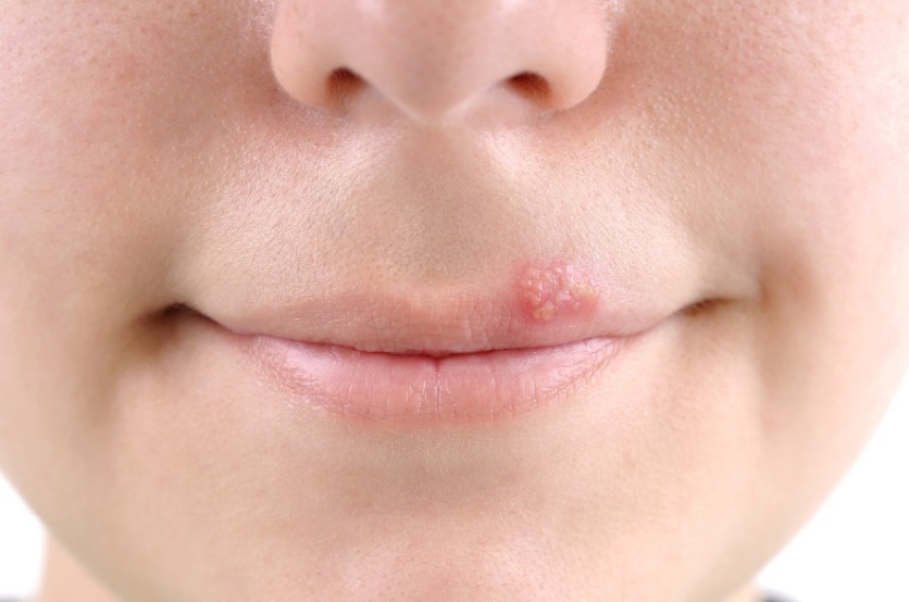 Pľuzgier – opar (herpes) v okolí sliznice úst