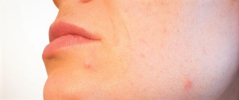 Ženská tvár, výrez, detail na pokožku brady, vyrážky, akné ako dôsledok mastnej pleti