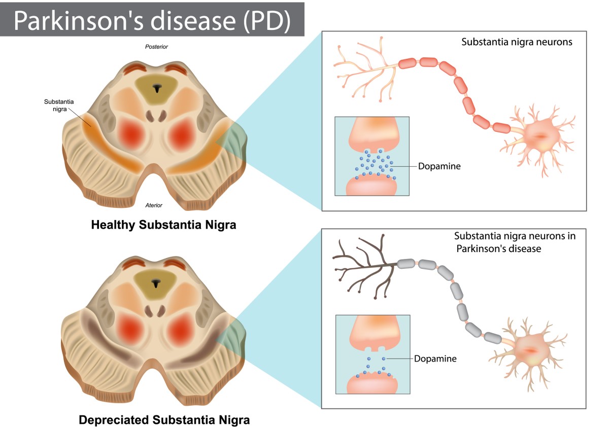 Parkinsonova choroba a nedostatočný prenos dopamínu v mozgu