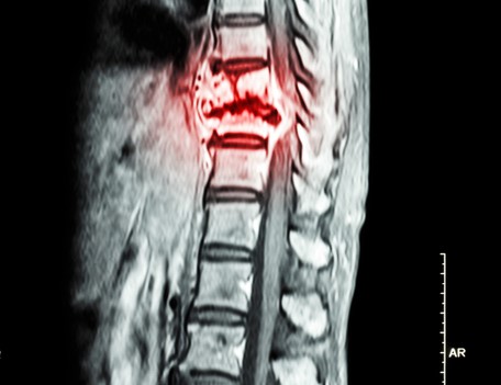 X-ray of the thoracic spine with evidence of cancer in the thoracic spine.
