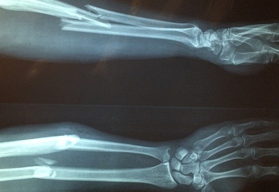 X-ray of the tibia with evidence of tibial fracture, complicated fracture with dislocation.