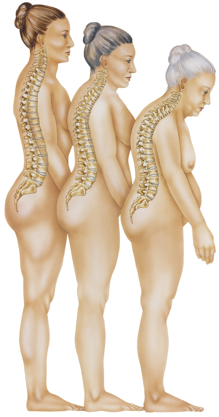 stojace postavy troch žien , znázorňujú degeneratívne zmeny postja následkom osteoporózy