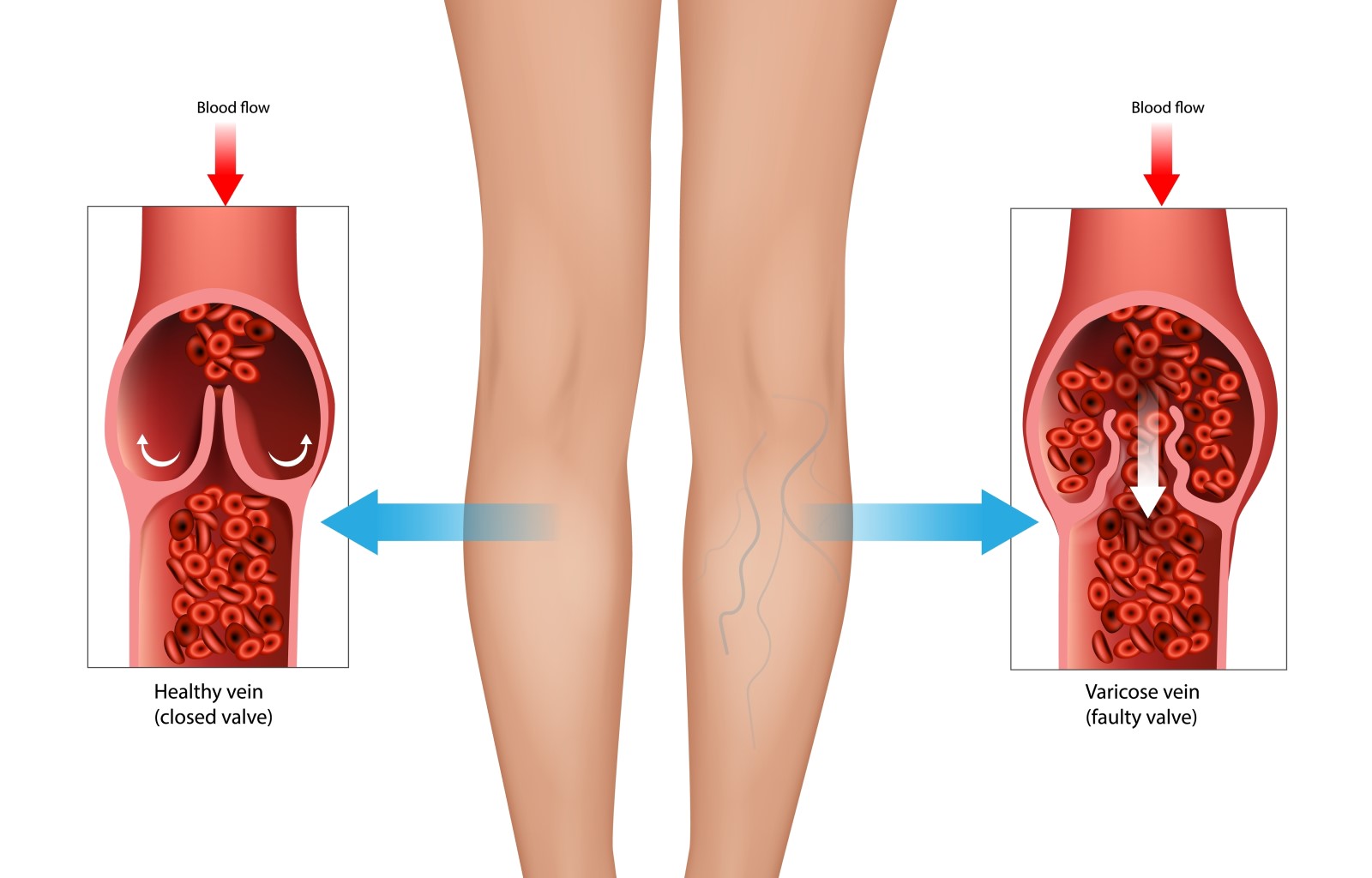 Anatomické a animované zobrazenie normálnej žily dolnej končatiny (naľavo) a kŕčovej žily (napravo)