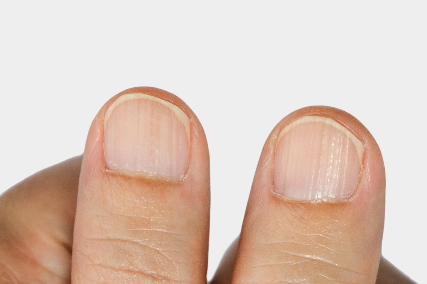 Vertikálne ryhy nechtov - prst, necht a ryhy