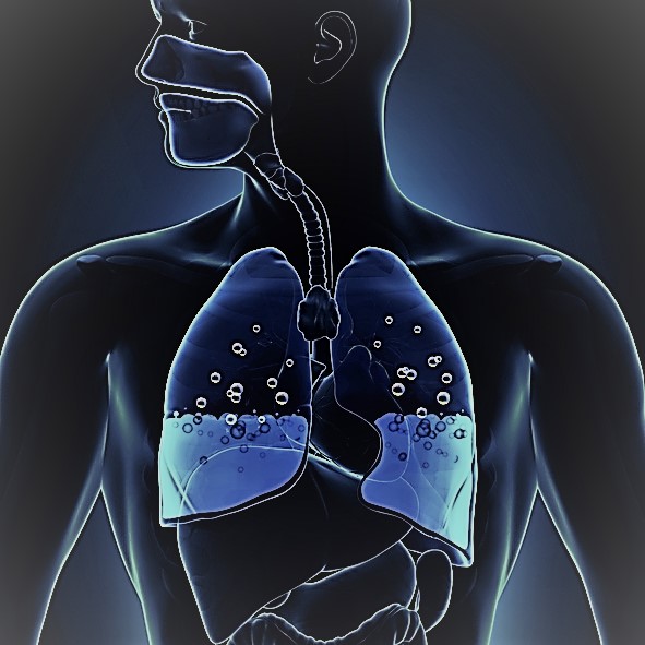 Schématické znázornenie pľúc s opuchom, voda do polovice pľúc, dýchacie cesty
