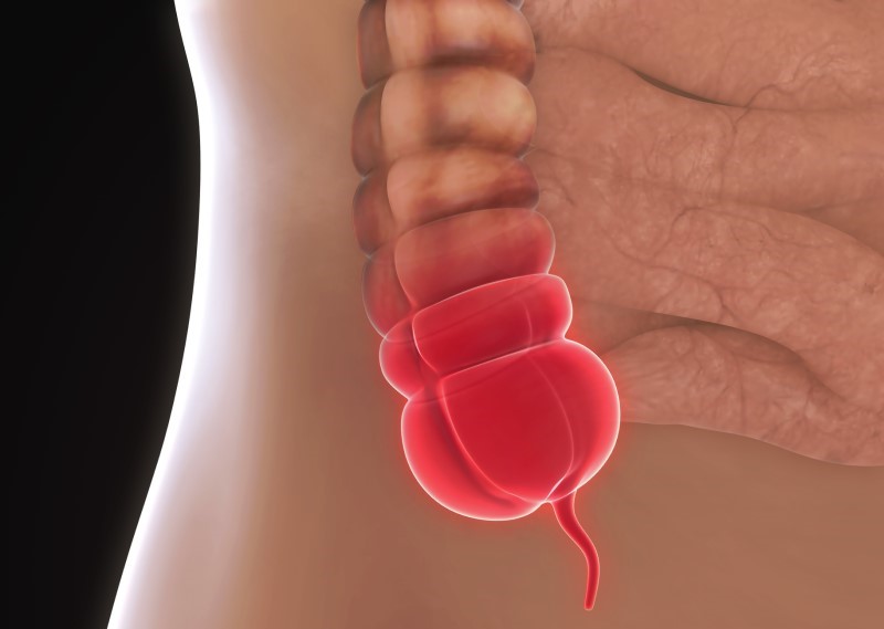 Model zapáleného apendixu - anatomické zobrazenie
