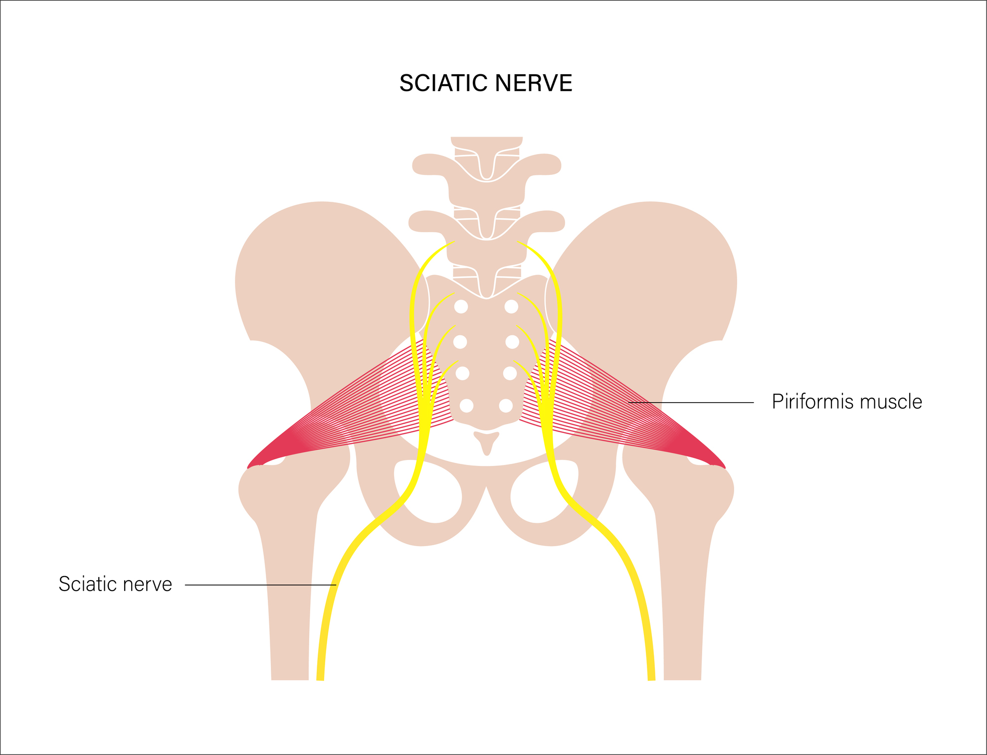 Zápal sedacieho nervu (ischias) a sval musculus Piriformis s tendenciou k stiahnutiu a kompresii