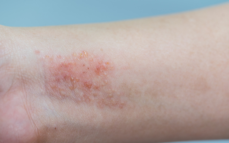 Ekzém na zápästí a predľaktí, mokvajúci, začervenaný zápal kože, napríklad kontaktná dermatitída