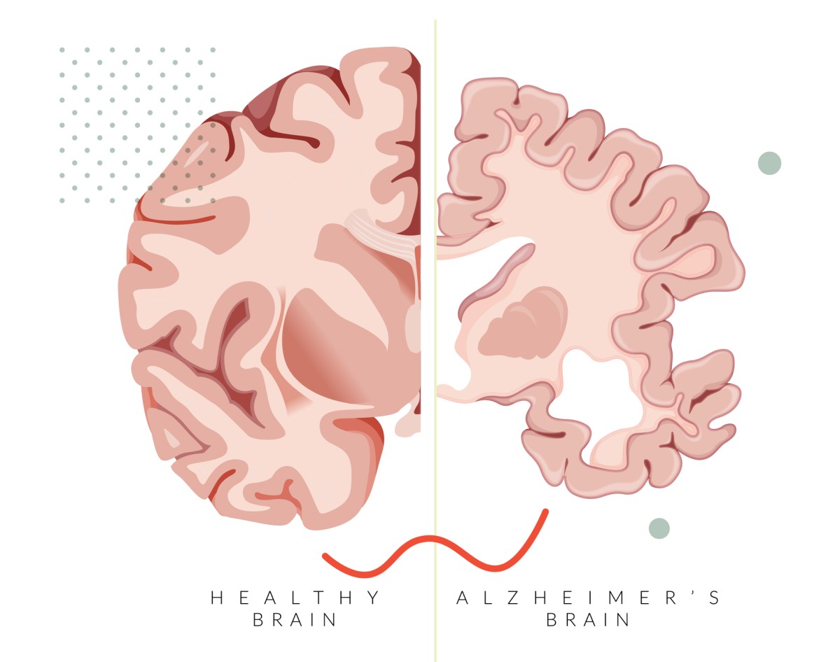 Porovnanie: zdravý mozog a mozog postihnutý Alzheimerovov chorobou s úbytkom buniek