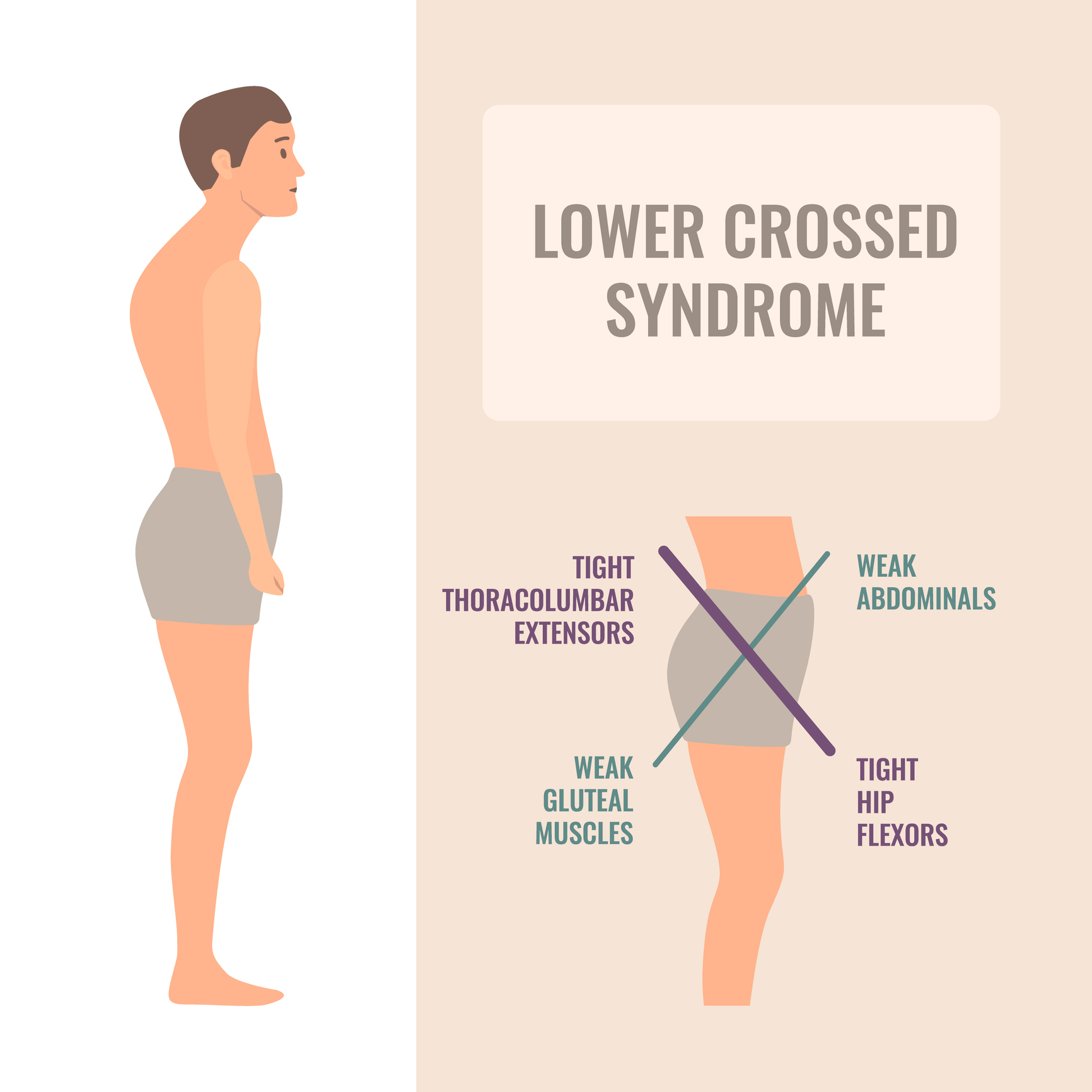Zlé držanie tela a svalové dysbalancie (dolný skrížený syndróm)