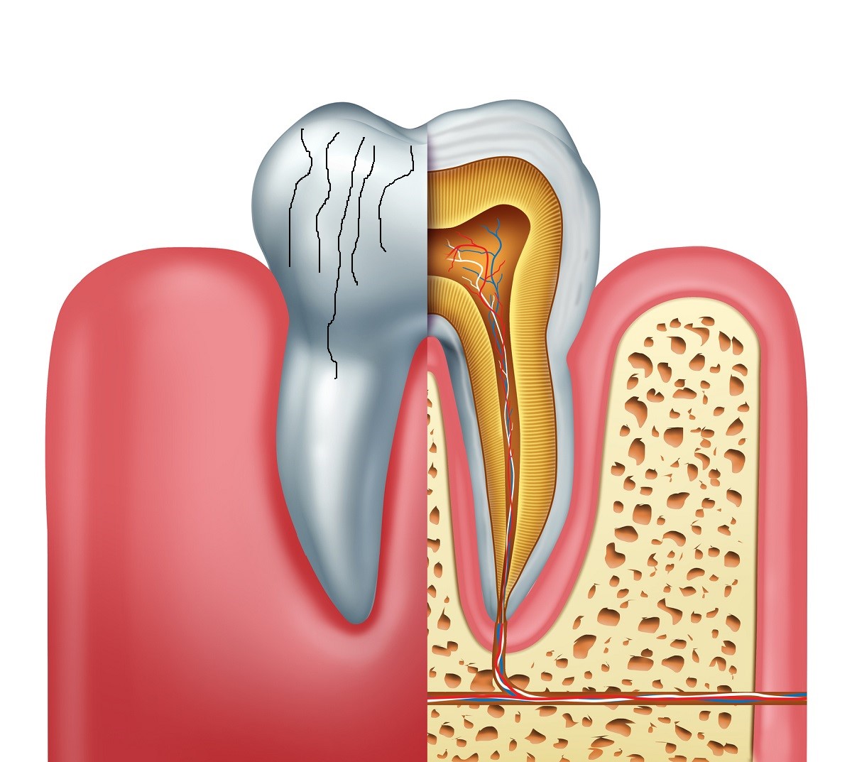 Znázornenie malých trhliniek na sklovine zubu