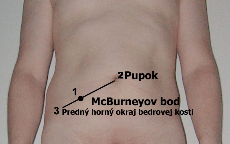 Obrázok znázorňuje umiestnenie slepého čreva - McBurneyov bod