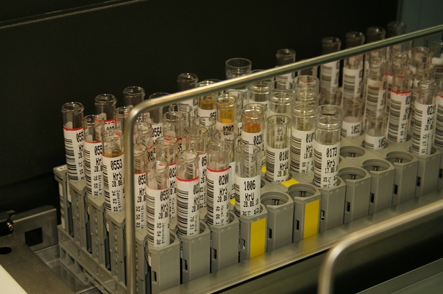 Základom diagnostiky je laboratórne vyšetrenie moču Vyšetrenie na krv v moči