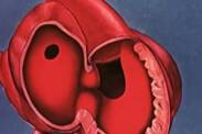 Koarktácia aorty