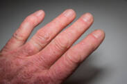 Psoriatická artritída