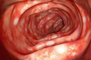 Ulcerózna kolitída