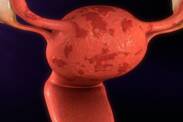 Ako spolu súvisí endometrióza a neplodnosť? + Ostatné príznaky a zdravotné ťažkosti