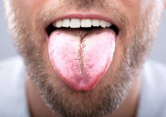 Biely povlak na jazyku
