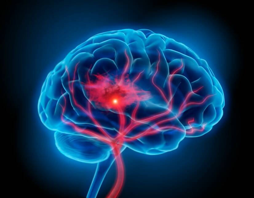 Krvácanie do mozgu: Prečo vzniká a aké má príznaky či liečbu?