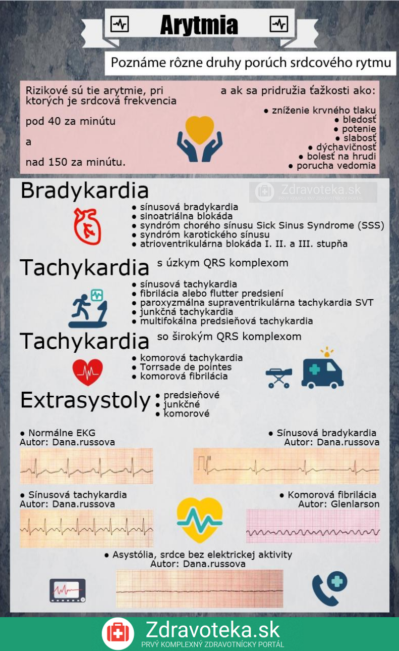 Infografika: Aké druhy arytmií poznáme + ukážky EKG záznamov