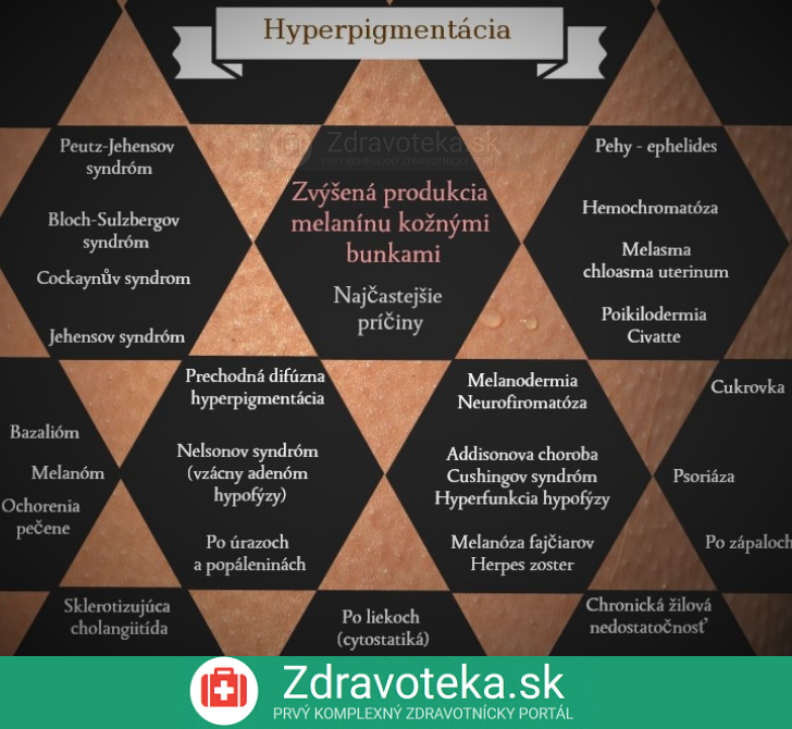 Infografika: Aké sú najčastejšie príčiny hyperpigmentácie?