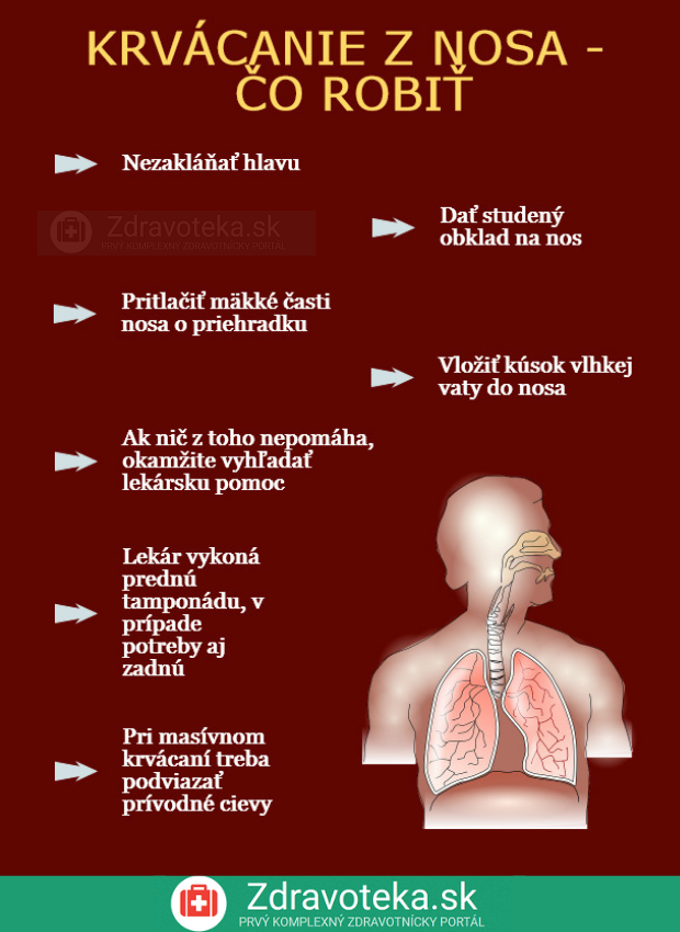 Infografika: Čo robiť pri krvácaní z nosa?