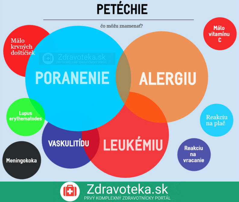 Infografika: Petéchie - najčastejšie príčiny