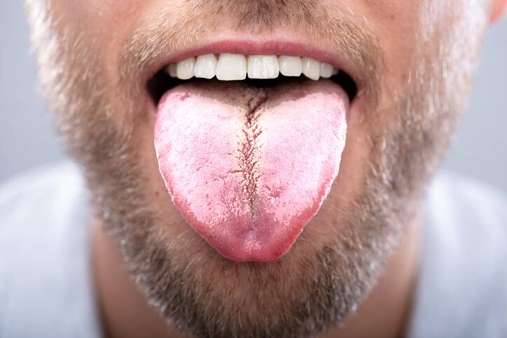 Biely povlak na jazyku: Aké má príčiny a ako ho odstrániť?