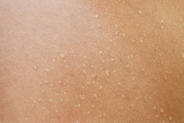 Mokvanie kože pre zápal, dermatitídu či ekzém? Spoznajte príčiny