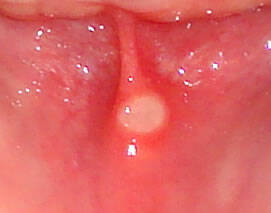 Malá afta na sliznici ústnej dutiny. Zdroj foto: Getty images