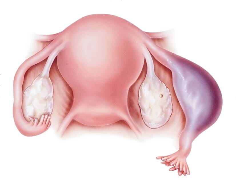 Vývoj a rast oplodneného vajíčka vo vajcovode a, hrozí jeho prasknutie a následné krvácanie. Zdroj: Getty Images