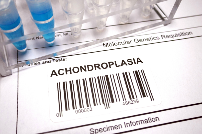 Achondroplázia: Aké sú príčiny, príznaky vrodenej poruchy kostí?