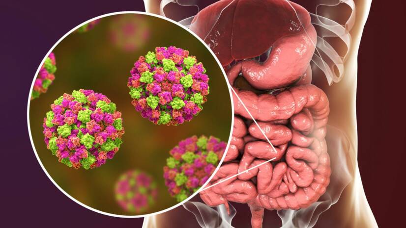 Norovírus: príznaky, príčiny a liečba brušnej virózy + Prevencia