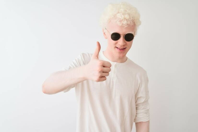 Albinizmus ako genetická porucha s dopadom na pokožku i oči
