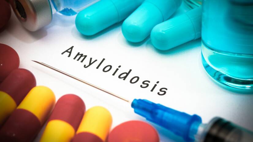 Amyloidóza: Ako spoznať vzácnu chorobu a moderná terapia, ktorá môže zmeniť život