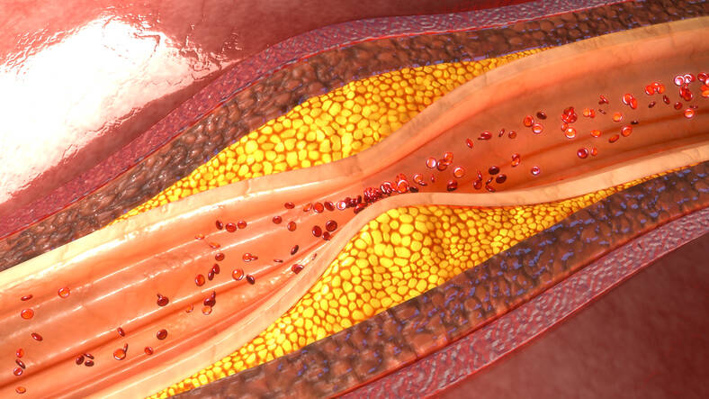 Ateroskleróza: Poznáte príznaky či príčiny vzniku, riziká, prevenciu?