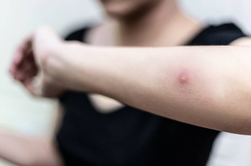 Kožný absces: Čo je, aké má príčiny a príznaky infekcia kože?