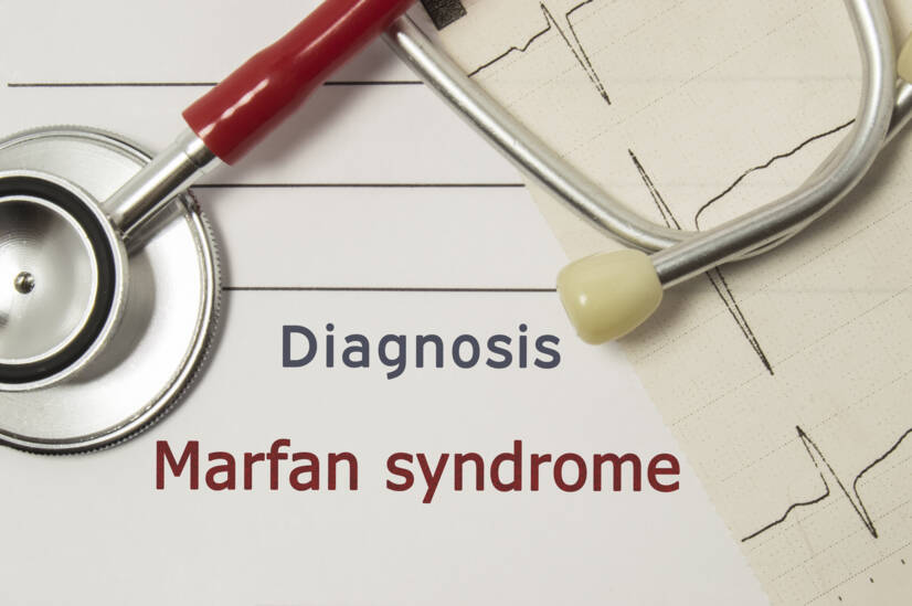 Čo je Marfanov syndróm? Všetko, čo treba vedieť o genetickej poruche