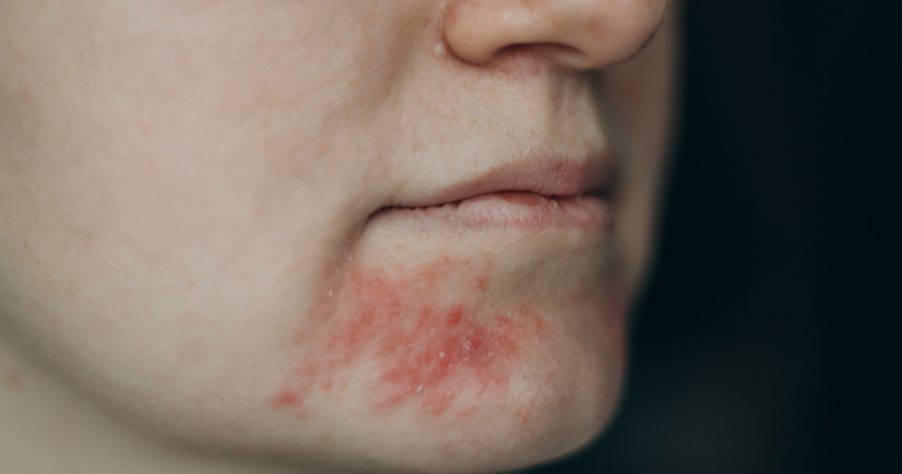 Periorálna dermatitída: čo to je a aké má príznaky? Prečo vzniká? + Liečba