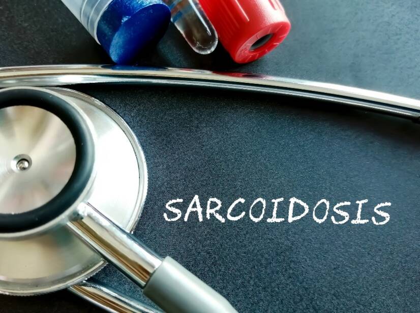 Sarkoidóza: Čo je a aké má príčiny/príznaky? Pľúcna i mimopľúcna forma