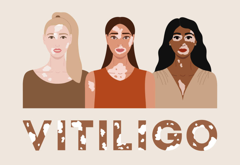 Vitiligo: Čo je a aké má príčiny a príznaky? Kedy začína?