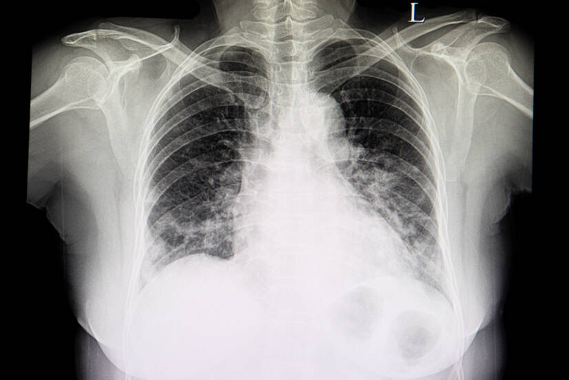 Ako sa prejavuje zápal pľúc, a aká liečba je najefektívnejšia?