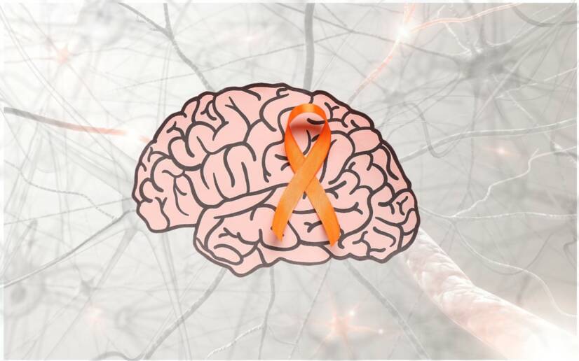 Čo sú to neurofilamenty a prečo sa vyšetrujú? Moderný nástroj v monitoringu sklerózy multiplex