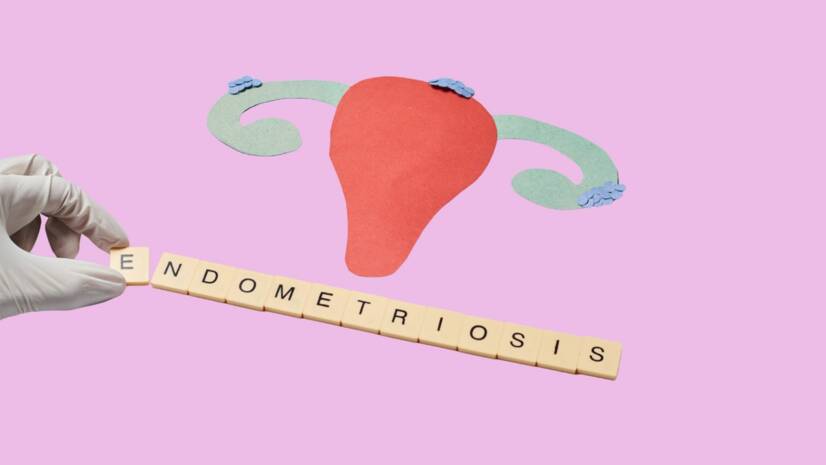 Endometrióza pod kontrolou: Ako dosiahnuť uspokojivé výsledky a zmierniť ťažkosti bez liekov?