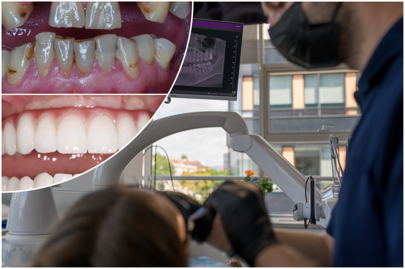Zubné implantáty zmenia život, prinavrátia sebavedomie a najmä zdravie